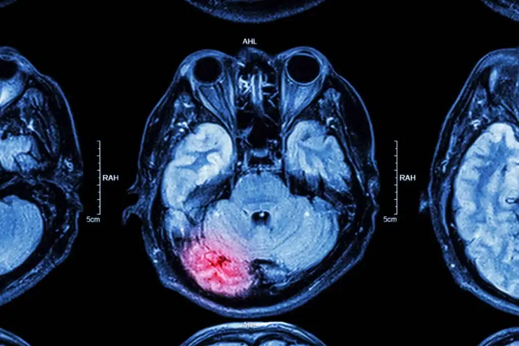 Scan results form a MRI showing a brain injury