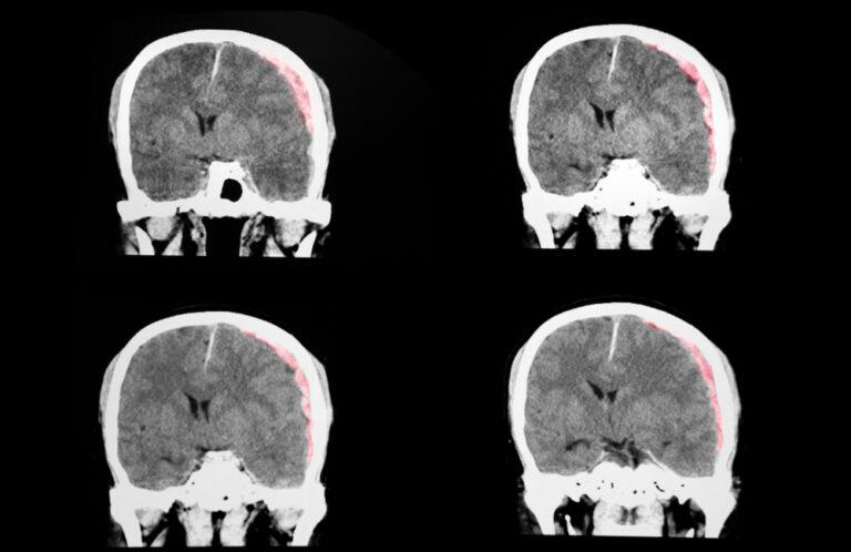 ¿Cuál es el acuerdo promedio por una lesión cerebral en Nueva York?